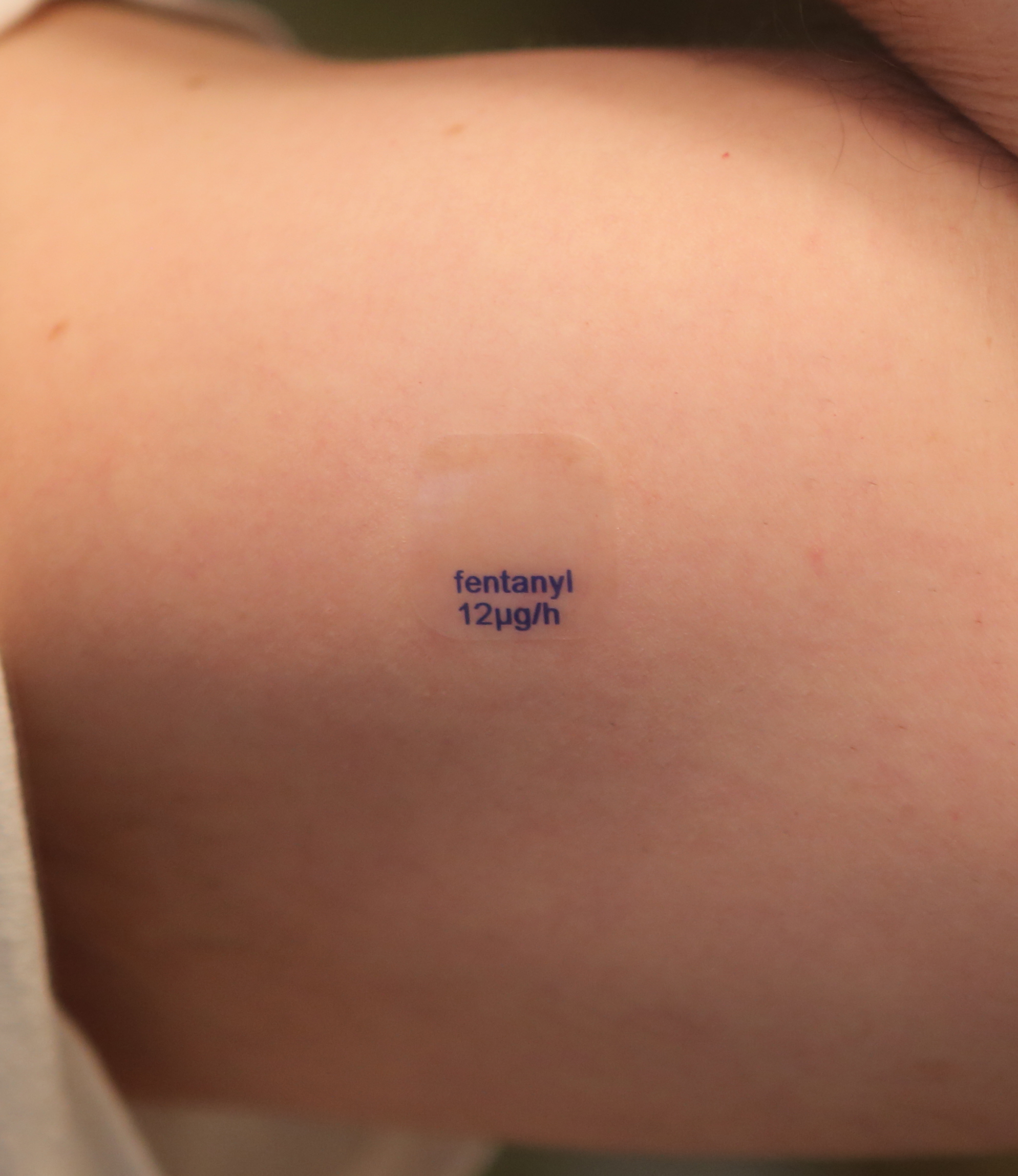 A generic fentanyl transdermal patch, with a release rate of 12mcg per hour, applied to the skin (cropped)
